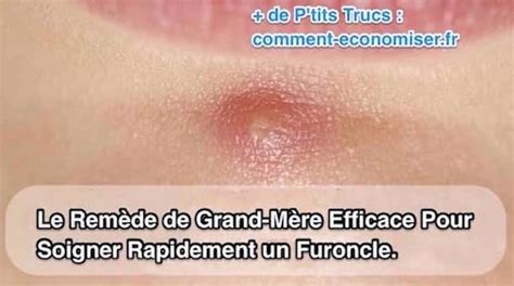 Comment traiter un furoncle du fessier